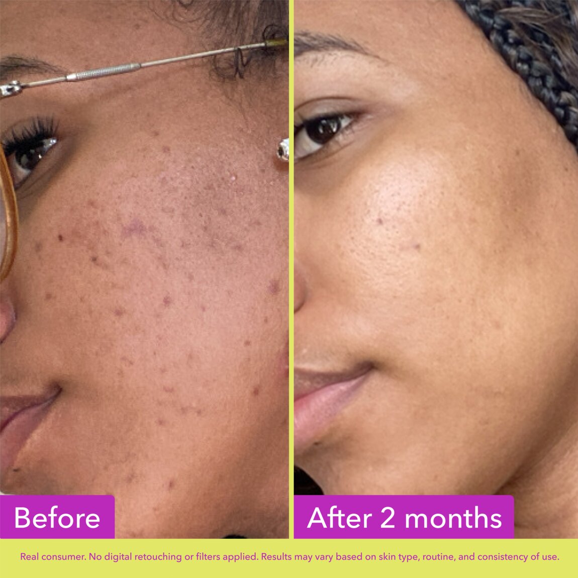 10% Azelaic Acid Treatment R3