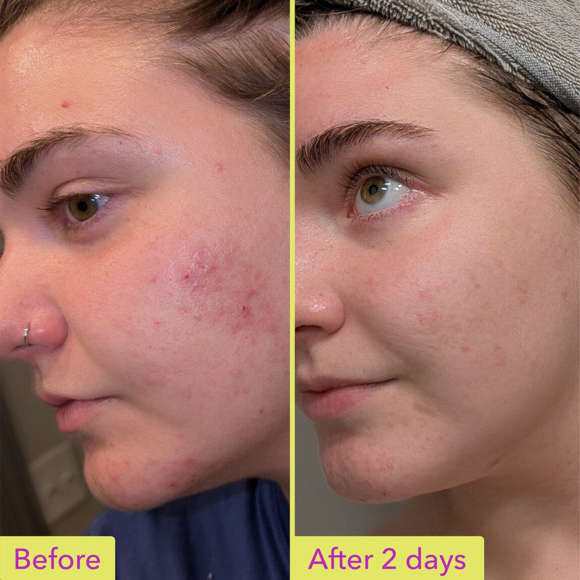 10% Azelaic Acid Treatment R3