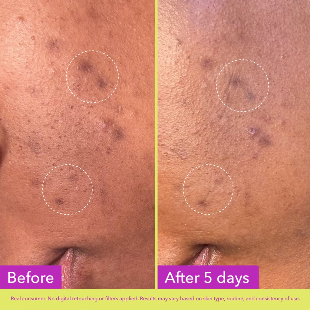 Dark Spot Microdart Patches Z4
