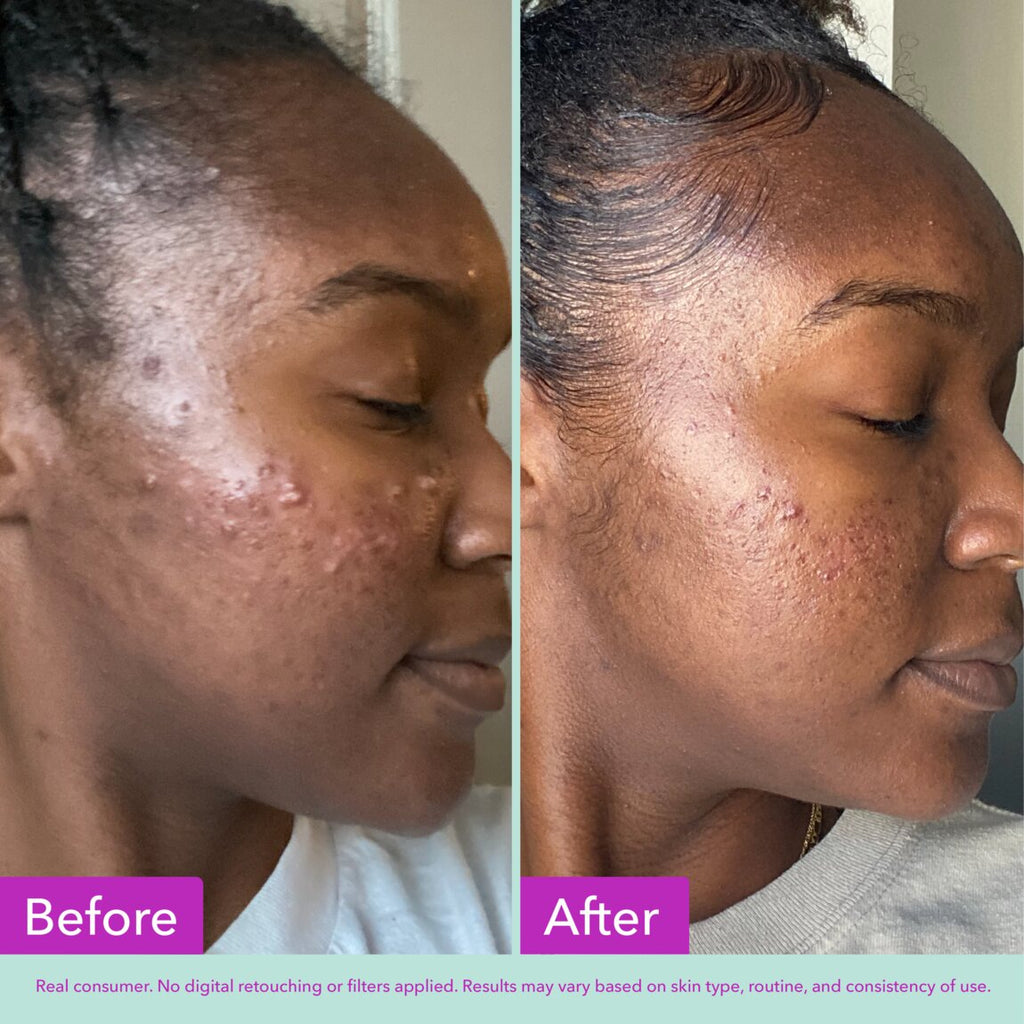 Acne Foaming Cleanser E1