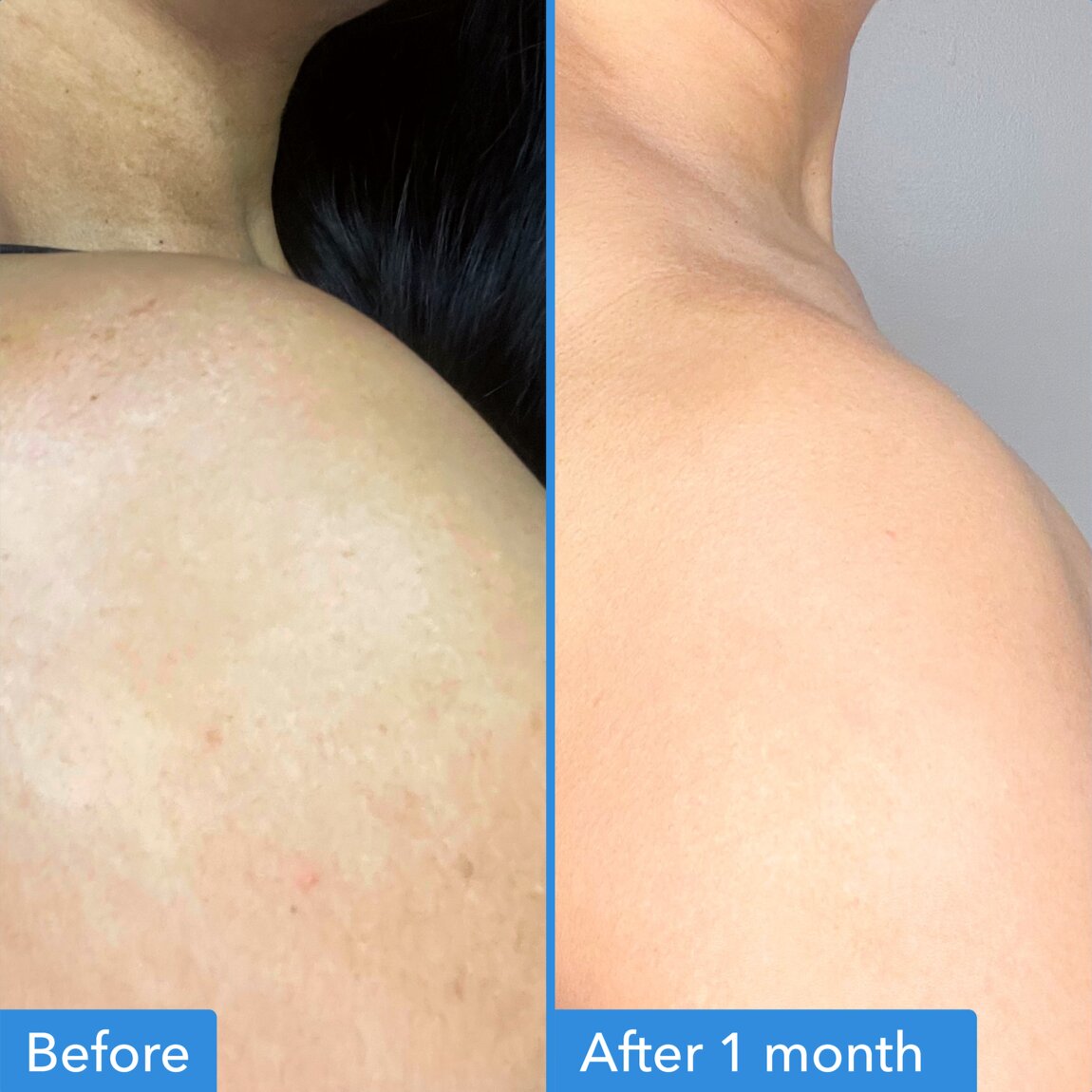 Discoloration Correcting Body Treatment F2