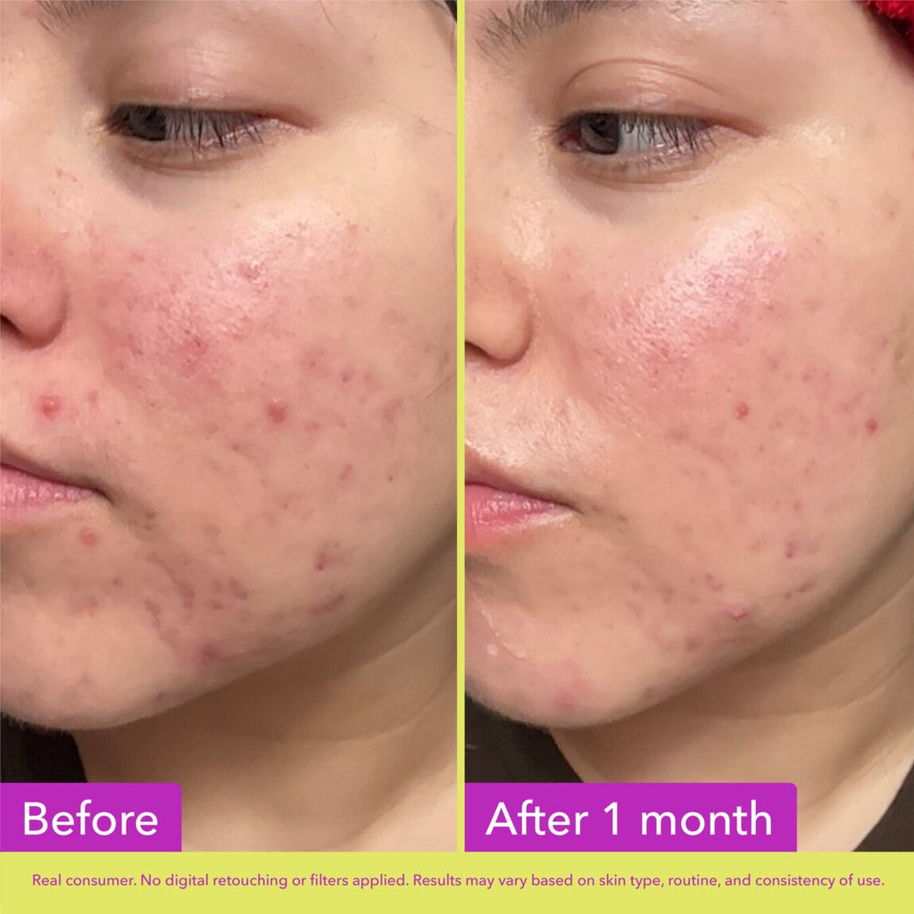 10% Azelaic Acid Treatment P5