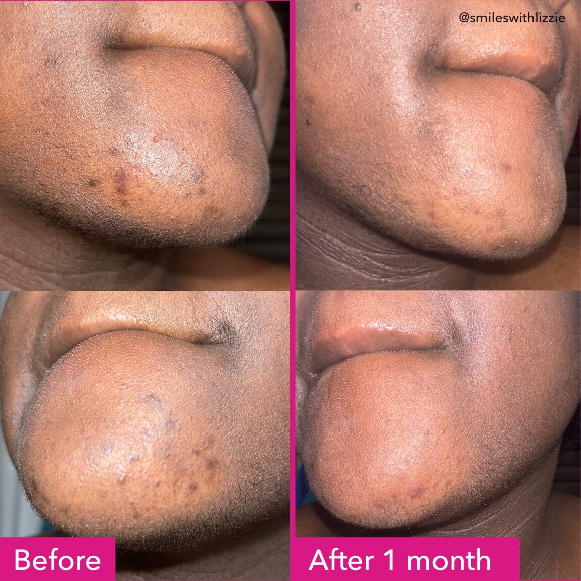 Brightening & Dark Spots Bar Z5